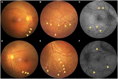 Case report: A rare appearance of preretinal deposits in a patient with uveitis: multimodal imaging observation